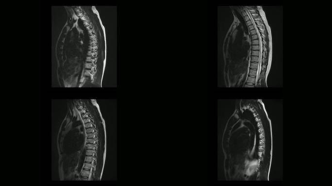 骨软骨病男性胸椎的计算机医学断层扫描MRI扫描