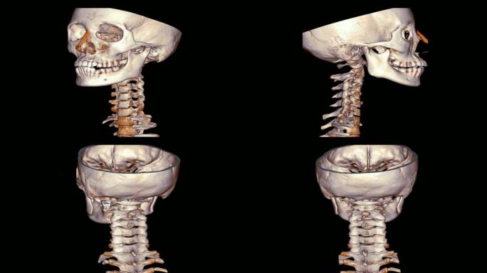 颈椎 (C-Spine) 的ct扫描3D渲染图像在黑色背景上旋转。