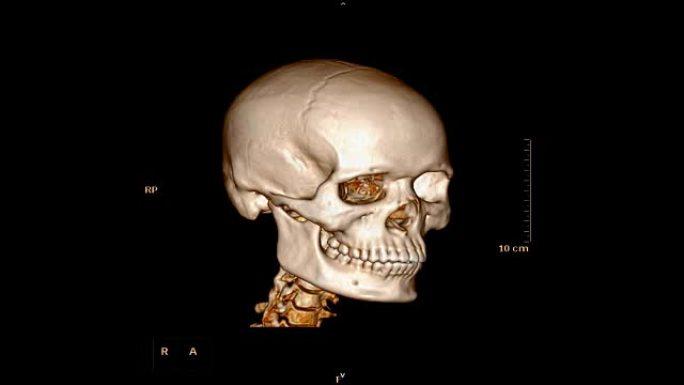 颅骨/面骨ct扫描在患者创伤病例中的应用