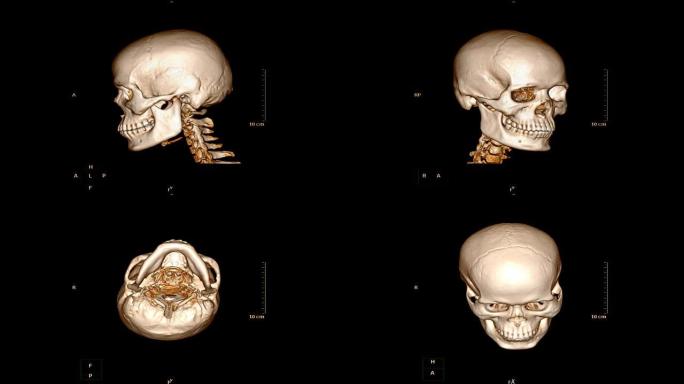 颅骨/面骨ct扫描在患者创伤病例中的应用