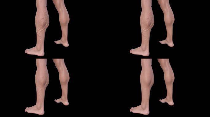 3D小腿静脉曲张一条腿对比病理恢复血管
