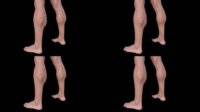 3D小腿静脉曲张一条腿对比病理恢复血管