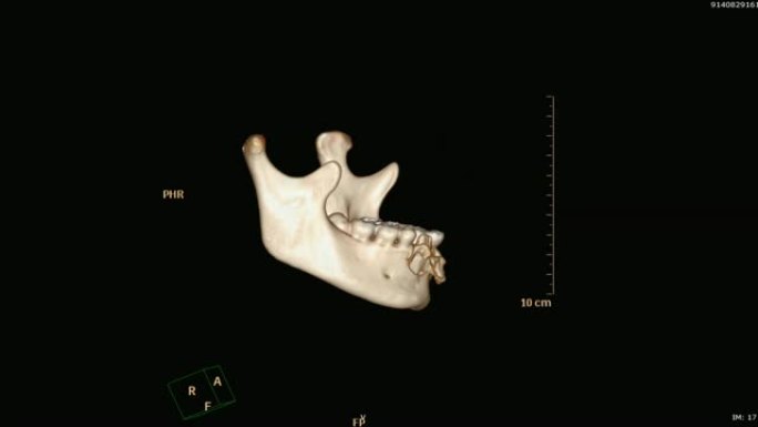 下颌骨的3D渲染图像