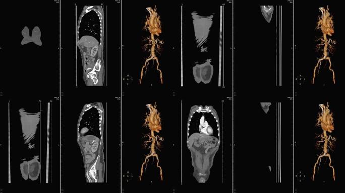 CTA腹主动脉。