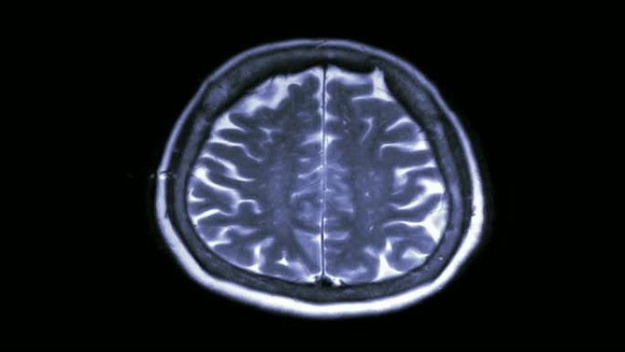 黑色背景上的MRI脑扫描轴向视图。磁共振成像。
