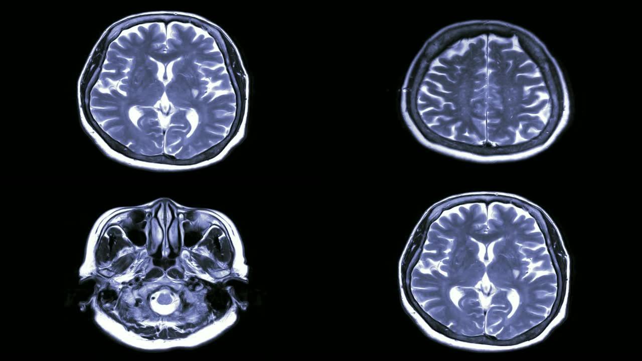 黑色背景上的MRI脑扫描轴向视图。磁共振成像。
