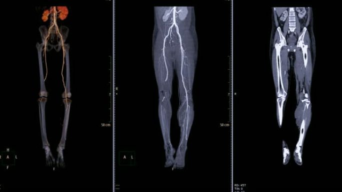 CTA股动脉脱落，3D渲染图像