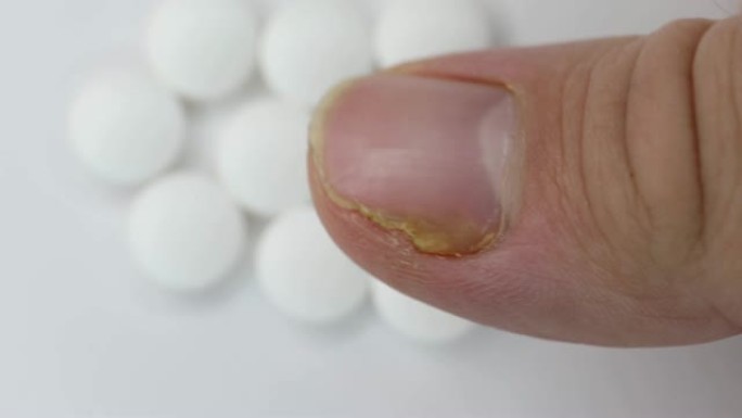 拇指手指上指甲真菌感染的特写