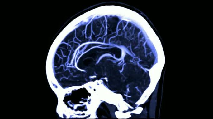 CTA脑或计算机断层血管造影的脑矢状视图/3D渲染图像显示人脑中的血管。