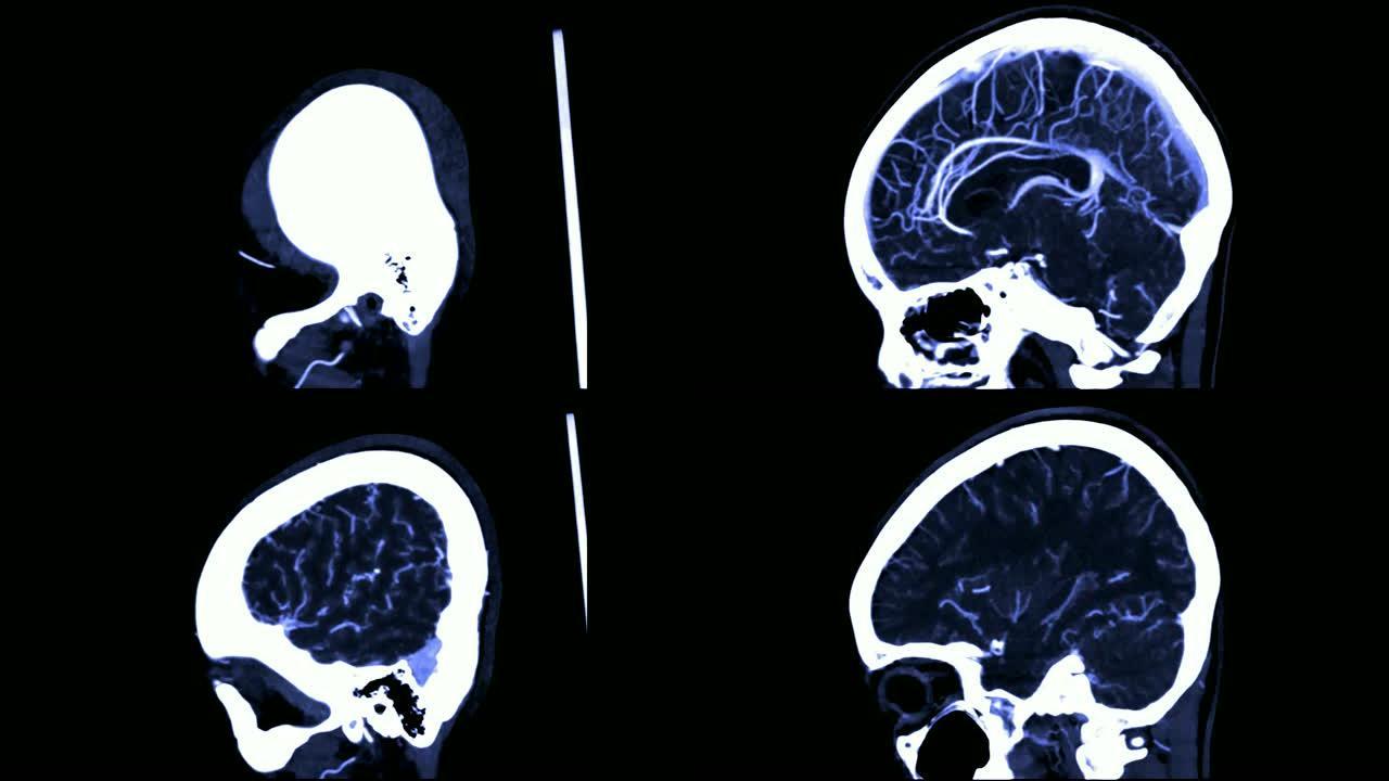 CTA脑或计算机断层血管造影的脑矢状视图/3D渲染图像显示人脑中的血管。