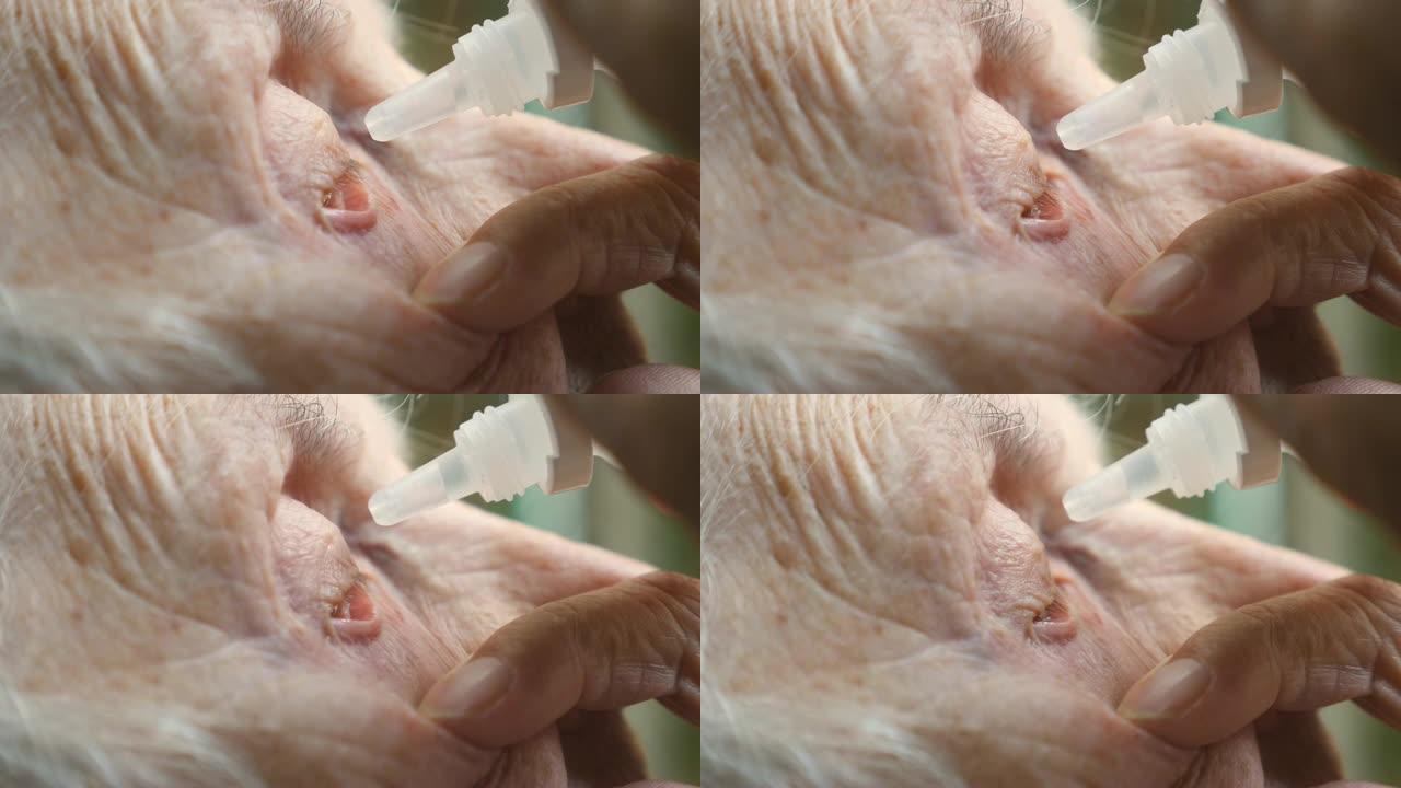 老妇人在她的眼睛里滴药水的侧写。感染和眼睛发炎的祖母肖像。医疗保健和医学的概念。侧视图关闭慢动作