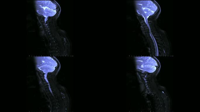 全脊柱MRI: 脊柱压迫脊髓 (脊髓病)。磁共振成像。