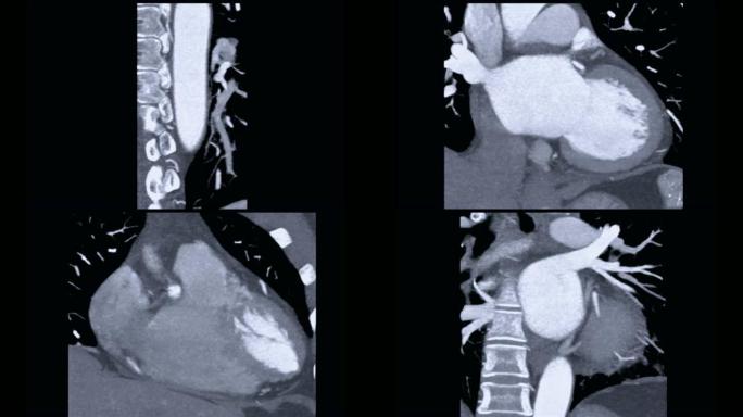 用MIP技术对冠状动脉或冠状动脉CTA进行CT血管造影显示心脏的解剖结构。