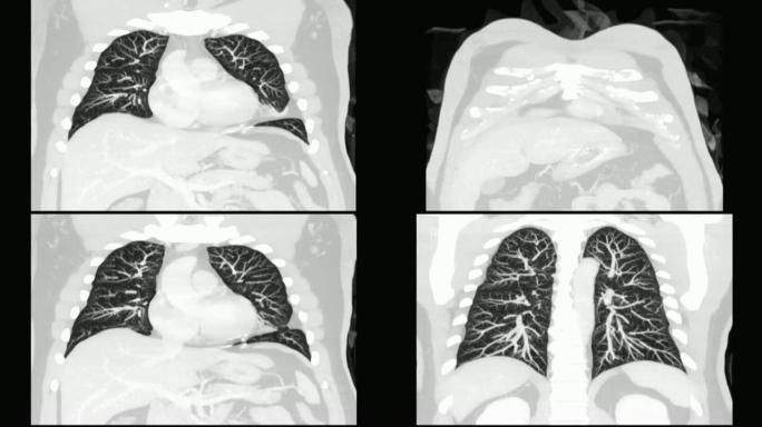 人胸部/肺部ct扫描。