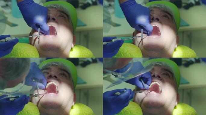 蛀牙去除过程。关闭牙医的手去除生病的牙齿