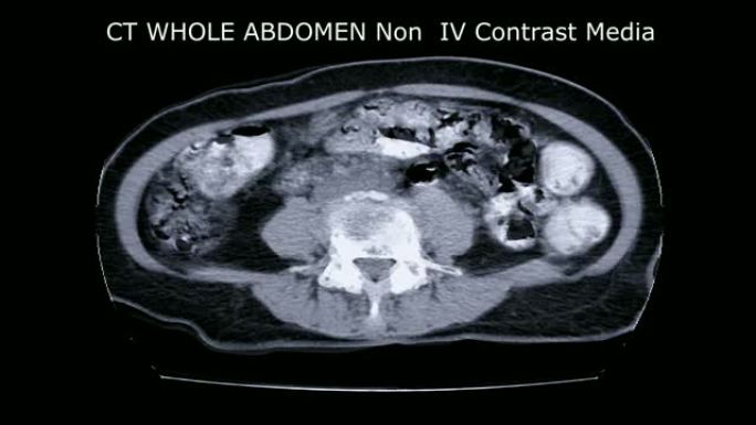 全腹部CT在轴位视图。