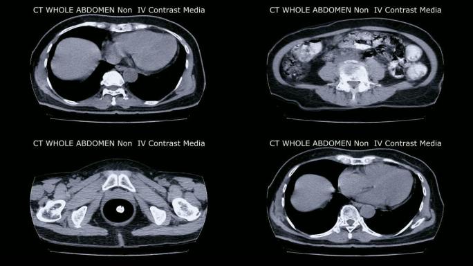 全腹部CT在轴位视图。
