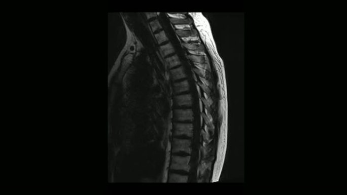 骨软骨病男性胸椎的计算机医学断层扫描MRI扫描