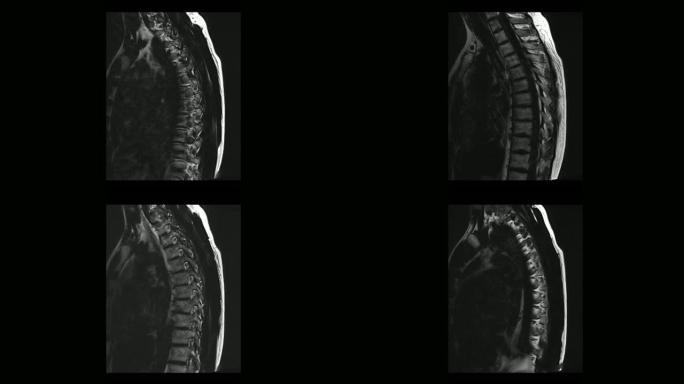 骨软骨病男性胸椎的计算机医学断层扫描MRI扫描