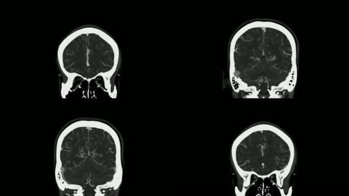 CTA脑或计算机断层血管造影的脑冠状视图/3D渲染图像显示人脑中的血管。