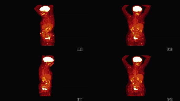 在屏幕上旋转的整个人体的计算机断层扫描 (PET/CT)。