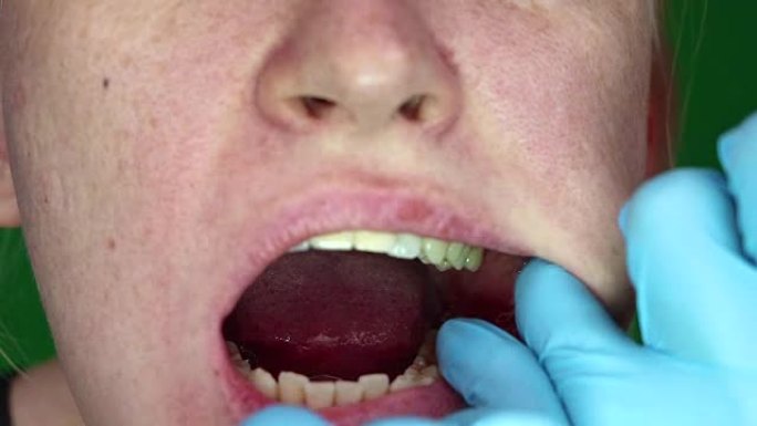 脸颊上有口腔炎的女人。拔除智齿后的后果。她的脸颊和伤口。可以近距离看到牙龈上的接缝。