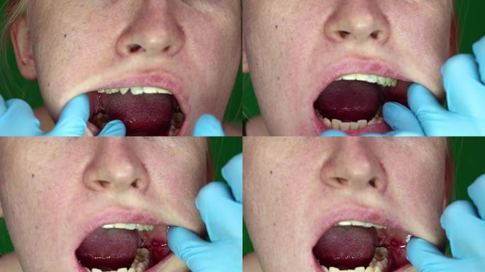 脸颊上有口腔炎的女人。拔除智齿后的后果。她的脸颊和伤口。可以近距离看到牙龈上的接缝。