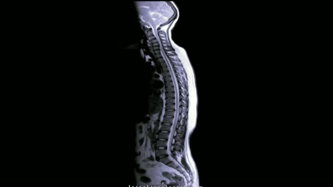 全脊柱MRI: 脊柱压迫脊髓 (脊髓病)。