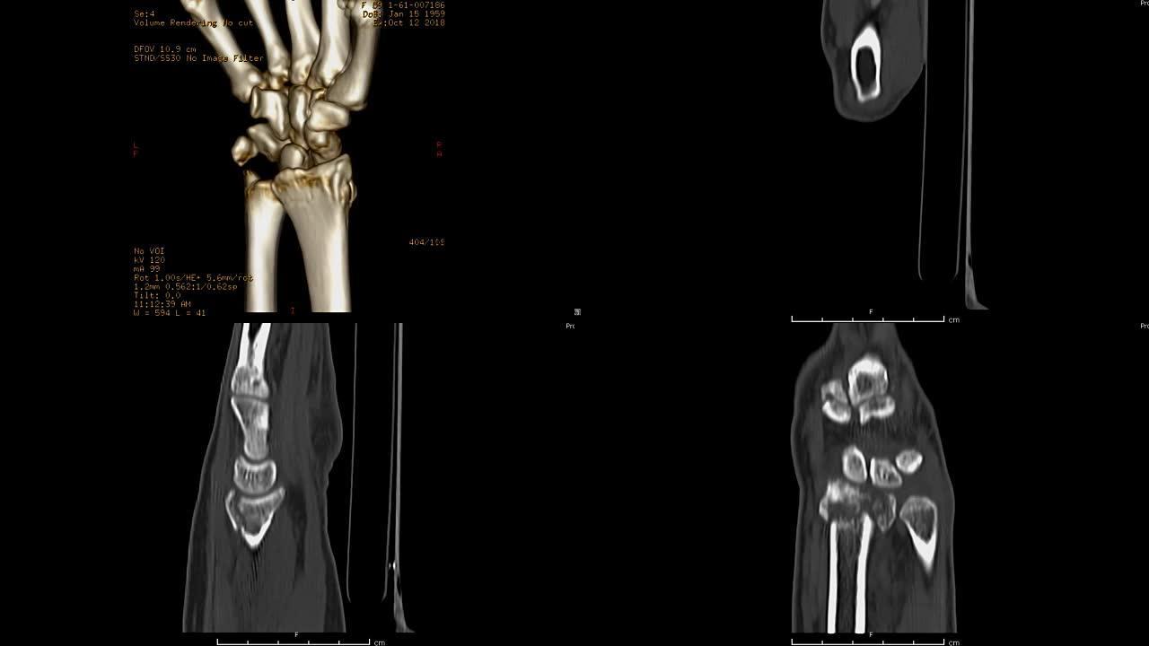 腕关节的ct扫描3D渲染图像和2D冠状和矢状视图。