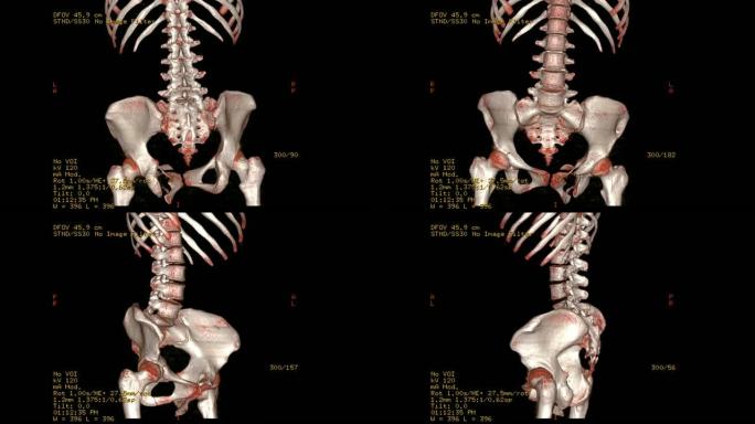 腰椎渲染图像的ct扫描图像。在监视器上旋转。
