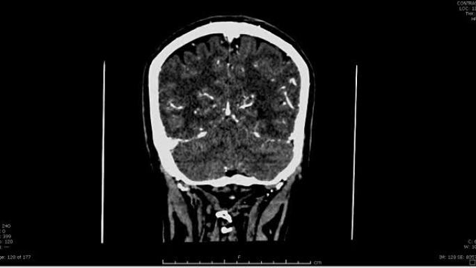 用造影剂对大脑进行ct扫描。
