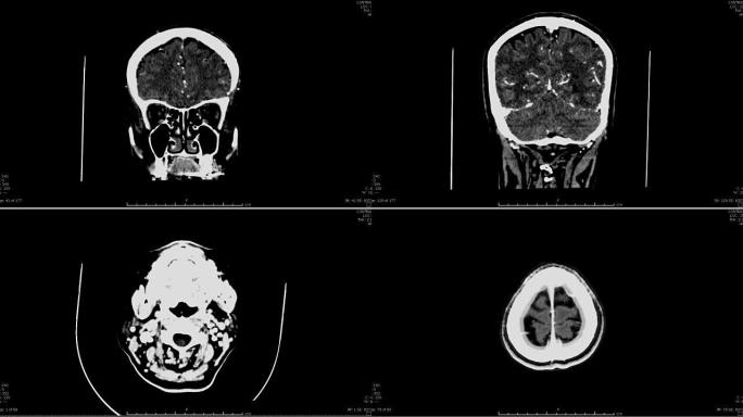 用造影剂对大脑进行ct扫描。