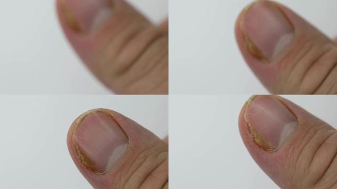 拇指手指上指甲真菌感染的特写