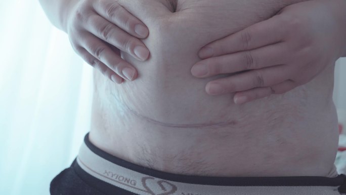 刨妇产刀口  刨妇产 疤痕 大肚子 肥胖