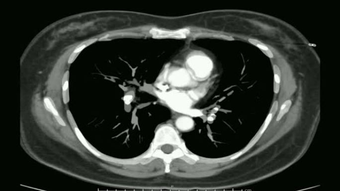 CTA胸部治疗肺栓塞。