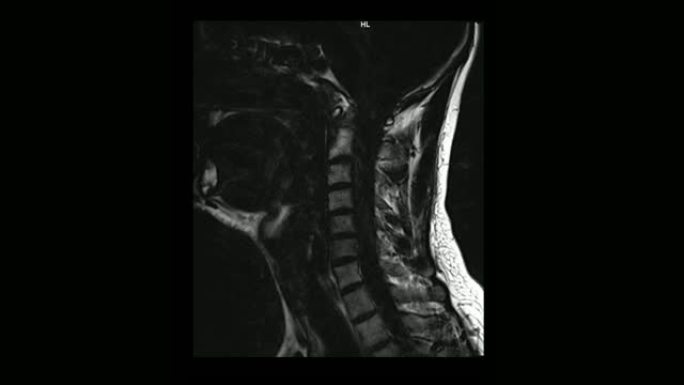 骨软骨病男性颈椎的计算机医学断层扫描MRI扫描