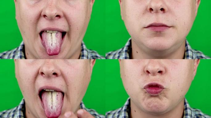 感染舌病白色念珠菌。绿色背景。Chromakey