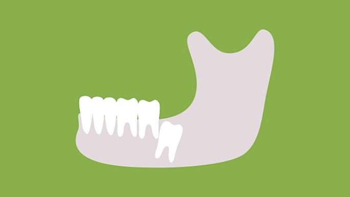 下颌骨或下颌智齿的类型