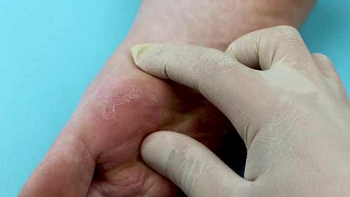 皮肤科医生检查病人。脚的真菌特写，孤立在蓝色背景上。皮肤病学的概念，治疗人类的真菌和真菌感染。宏观拍