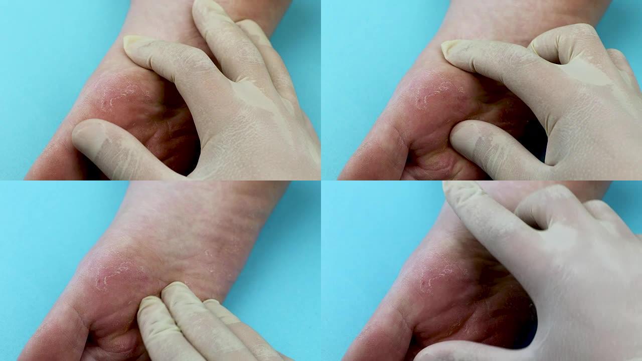 皮肤科医生检查病人。脚的真菌特写，孤立在蓝色背景上。皮肤病学的概念，治疗人类的真菌和真菌感染。宏观拍