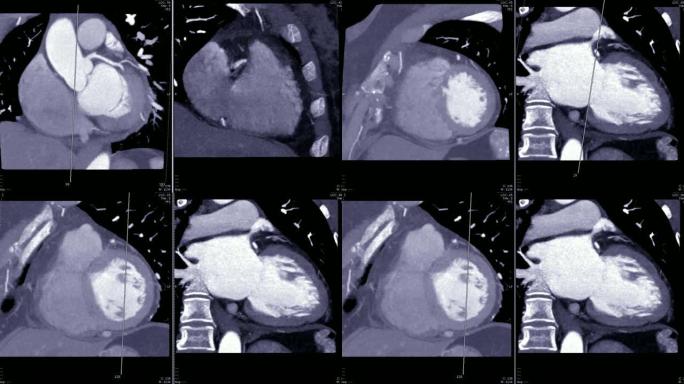 采用MIP技术对冠状动脉冠状斜视进行CT血管造影 (CTA)，显示心脏的解剖结构。