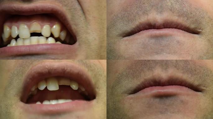 断牙。男人嘴里的上门牙断裂。