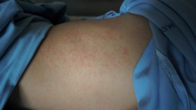 皮疹是由于登革热引起的。