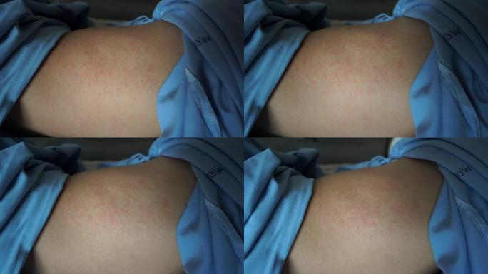皮疹是由于登革热引起的。