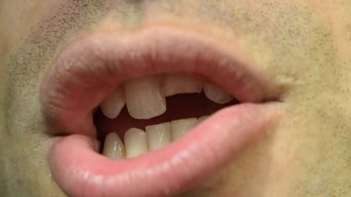 断牙。男人嘴里的上门牙断裂。