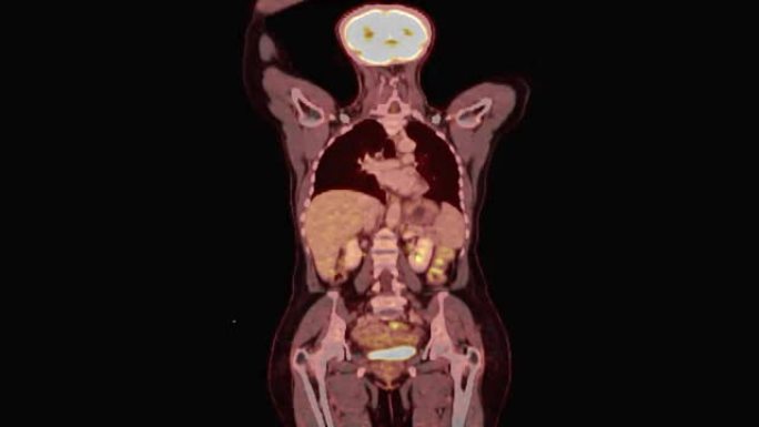 (PET/CT) 全身冠状视图。