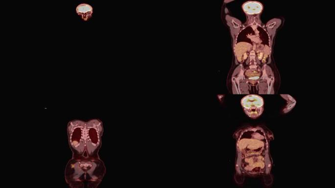 (PET/CT) 全身冠状视图。