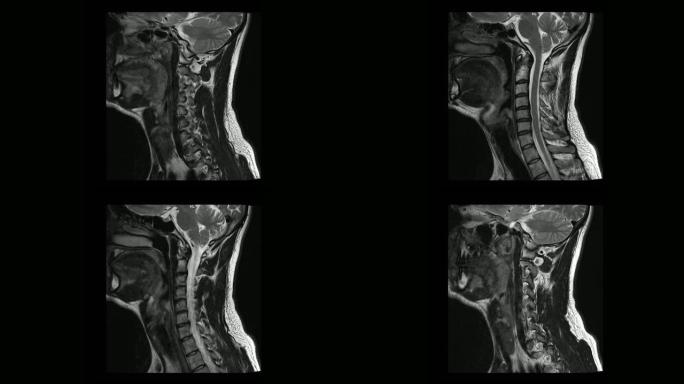 骨软骨病男性颈椎的计算机医学断层扫描MRI扫描