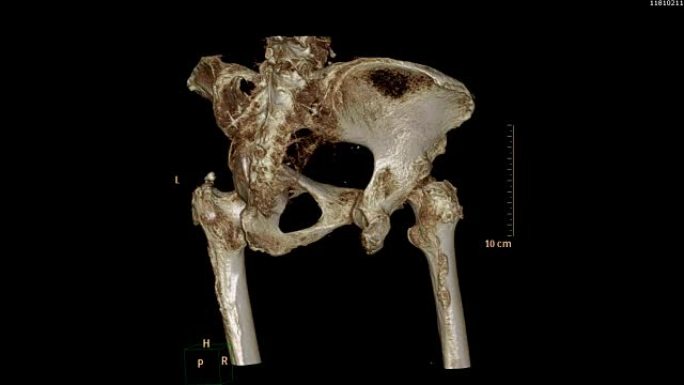 骨盆骨/髋骨的ct扫描图像。
