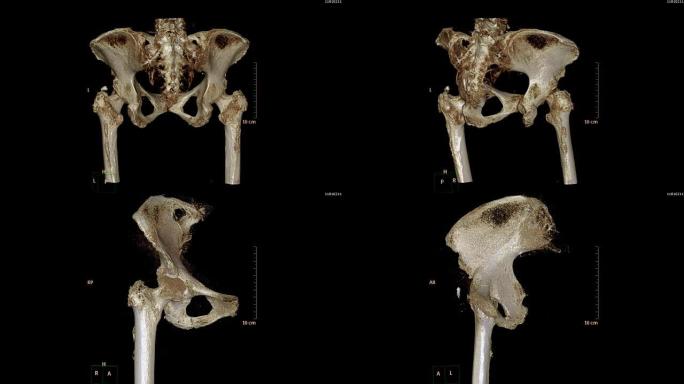 骨盆骨/髋骨的ct扫描图像。